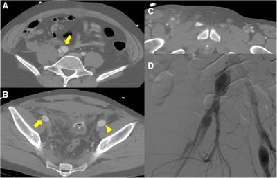 Case Report: Hybrid approach as a Rescue Treatment in a patient with vascular Ehlers–Danlos Syndrome